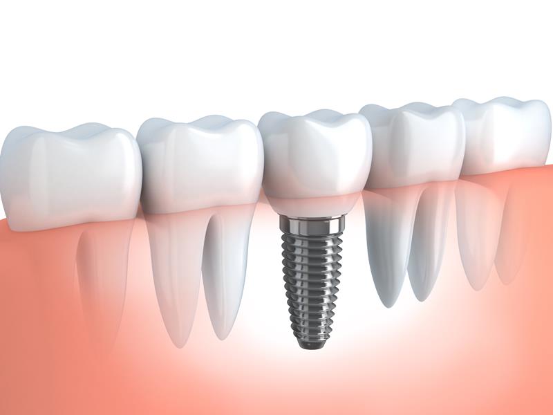 Dental Implants Spring, TX